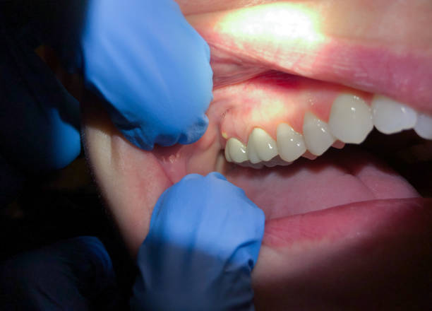 Best Dental Abscess Treatment in Evans, GA